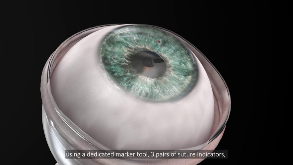 Israel cria córnea sintética que faz cegos recuperarem a visão